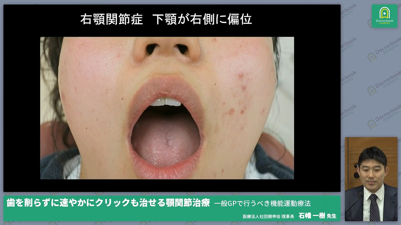 歯を削らずに速やかにクリックも治せる顎関節治療 - 一般GPで行うべき機能運動療法|DOCTORBOOK